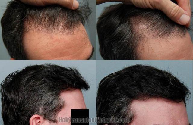 Right view - Before and after hair transplant result image