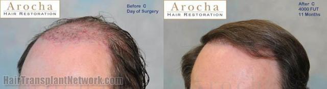 Hair restoration procedure result images before and after