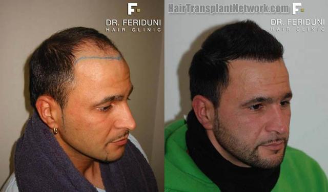 Right view before and after hair transplantation