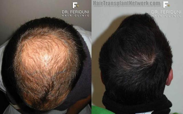 Views of the crown before and after hair transplant