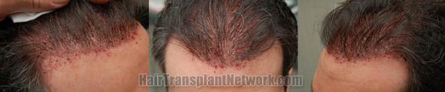 immediate postoperative images from hair transplantation