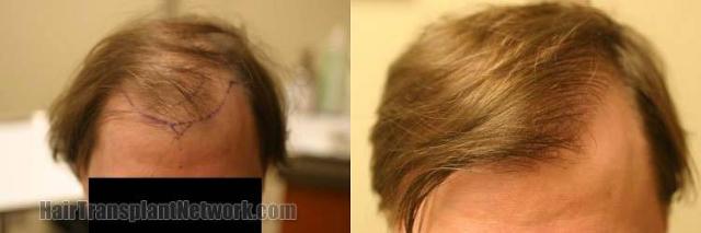 Hair restoration procedure before and after results