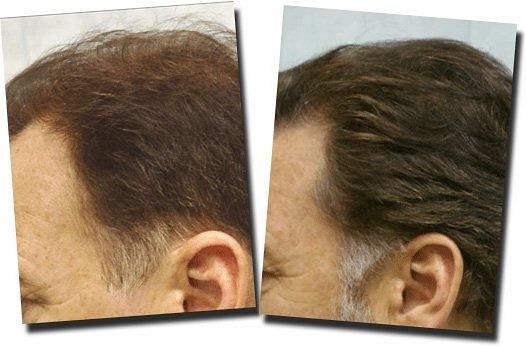 Hair restoration procedure results