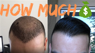 How Much Should You Pay For Your First Hair Transplant?