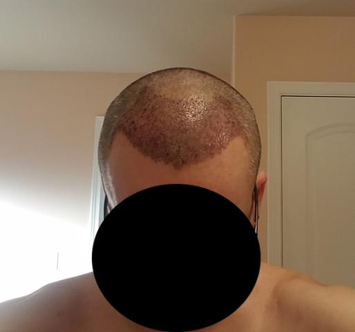 Three days after the hair transplant