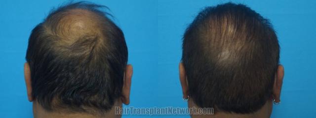 Back view before and after hair transplantation 