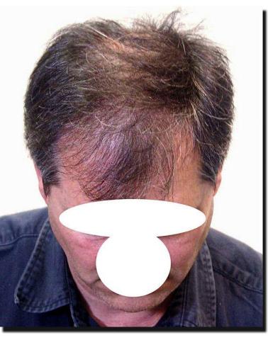 Hair restoration procedure results