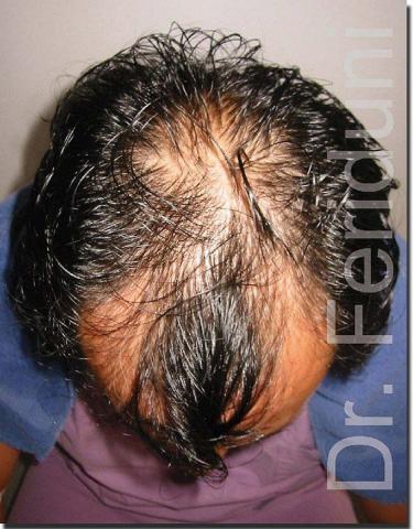 Hair restoration procedure results