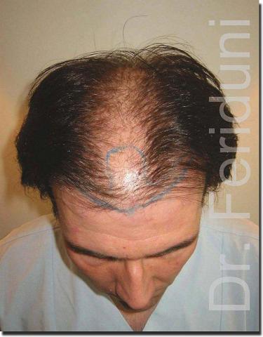 Hair restoration procedure results