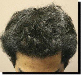 Hair restoration procedure results