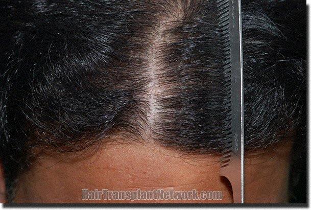 Hair restoration procedure results