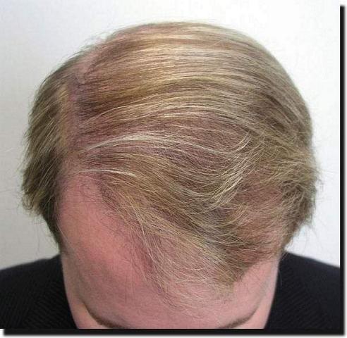 Hair restoration procedure results