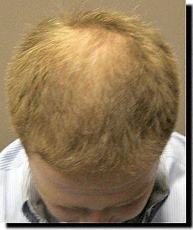 Hair restoration procedure results