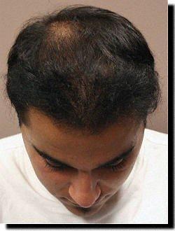 Hair restoration procedure results