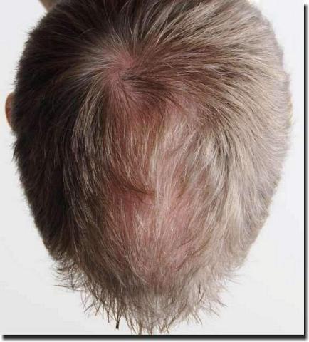 Hair restoration procedure results