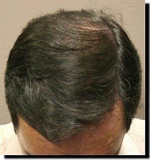 Hair restoration procedure results