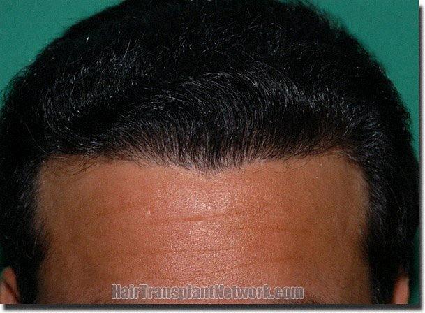 Hair restoration procedure results