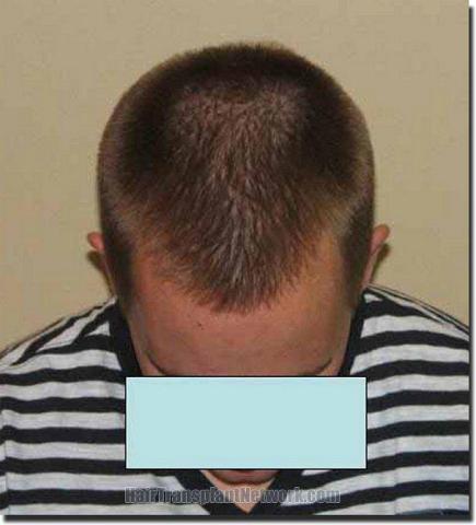 Hair restoration procedure results