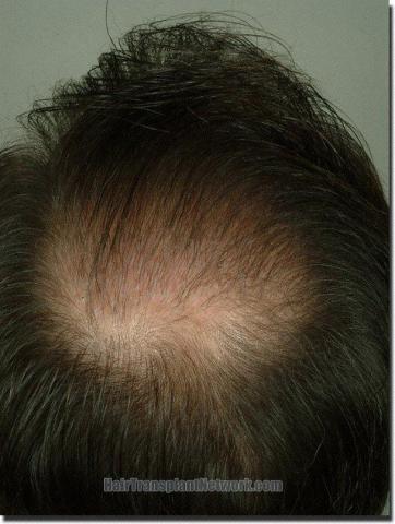 Hair restoration procedure results