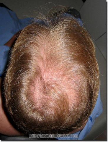 Hair restoration procedure results