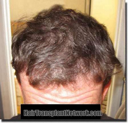 Hair restoration procedure results