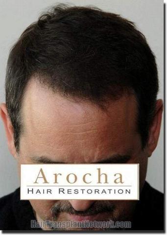 Hair restoration procedure results