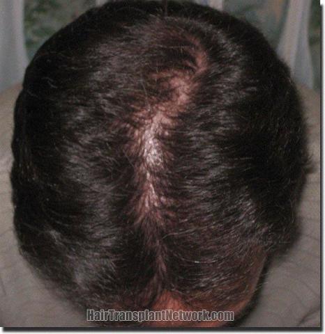 Hair restoration procedure results