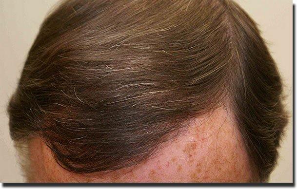 Hair restoration procedure results