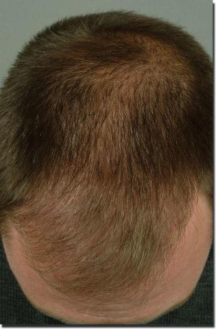 Hair restoration procedure results