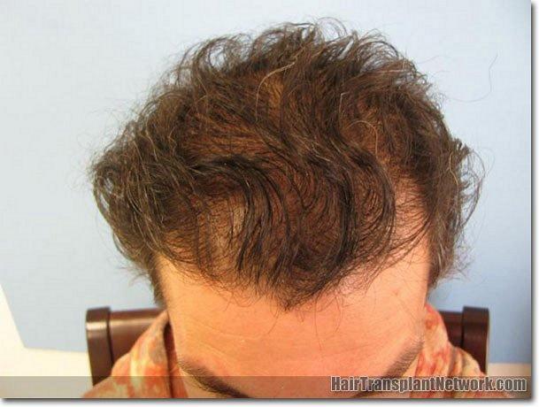 Hair restoration procedure results