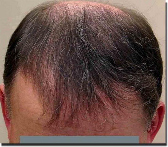 Hair restoration procedure results