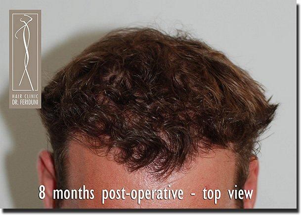 Hair restoration procedure results