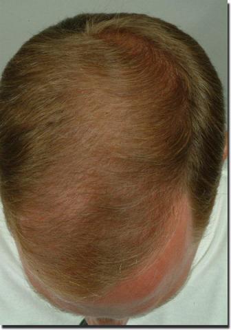 Hair restoration procedure results