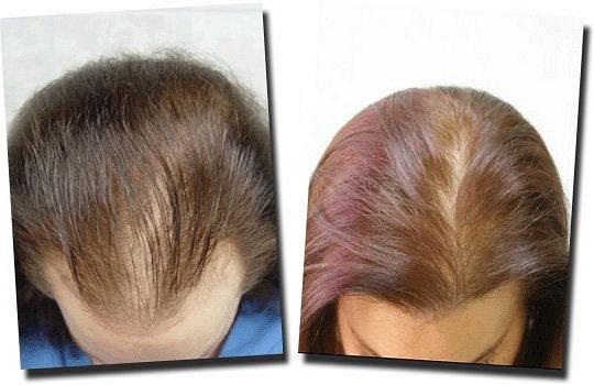 Hair restoration procedure results