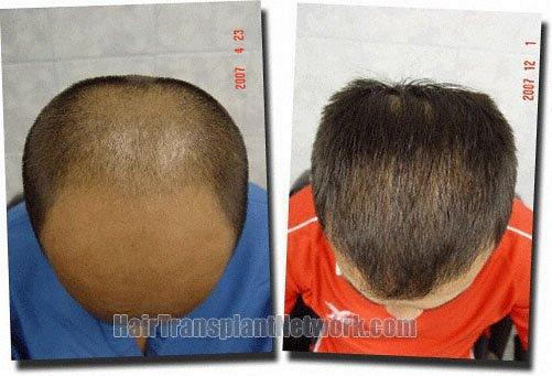 Hair restoration procedure results