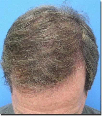 Hair restoration procedure results