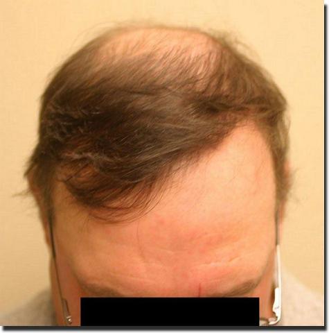 Hair restoration procedure results