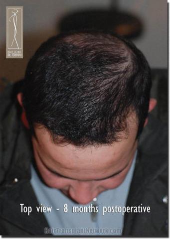 Hair restoration procedure results