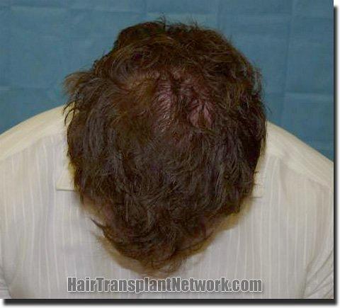 Hair restoration procedure results