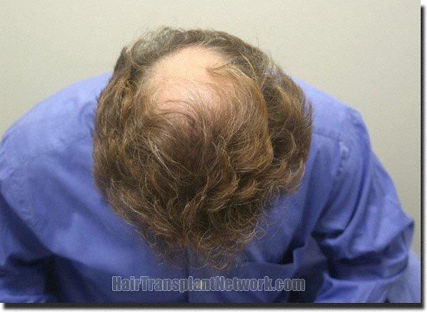 Hair restoration procedure results