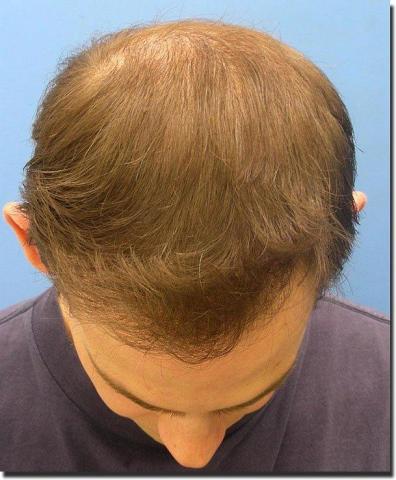 Hair restoration procedure results