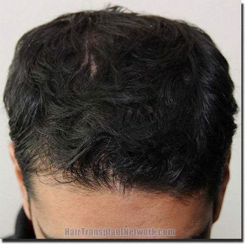 Hair restoration procedure results