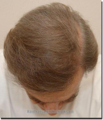 Hair restoration procedure results