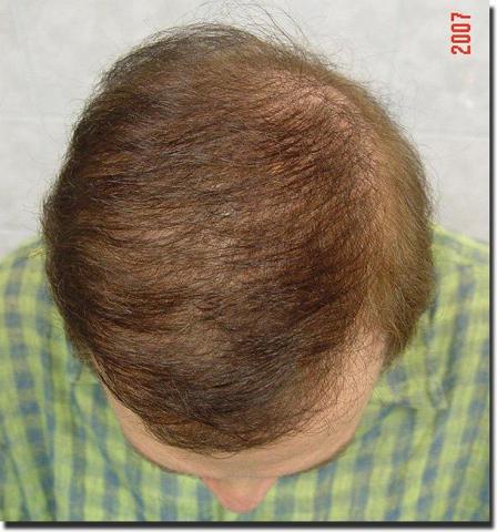 Hair restoration procedure results