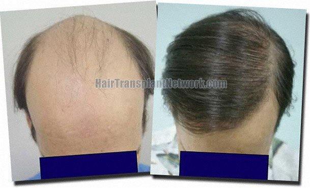 Hair restoration procedure results