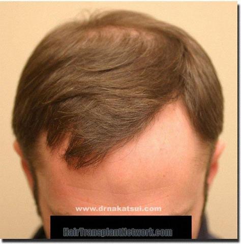 Hair restoration procedure results