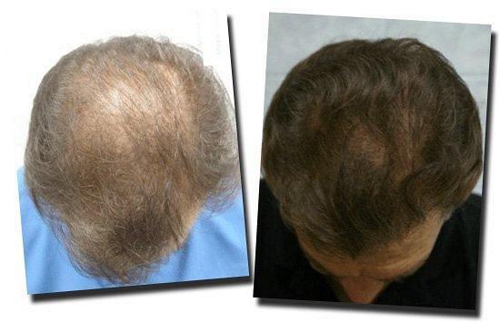 Hair restoration procedure results