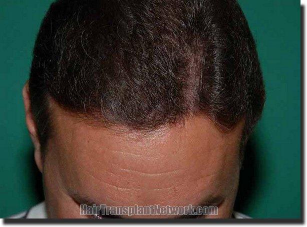 Hair restoration procedure results