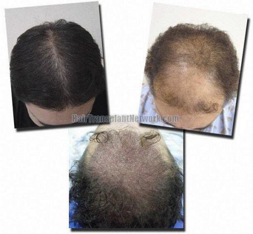 Hair restoration procedure results