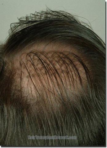 Hair restoration procedure results